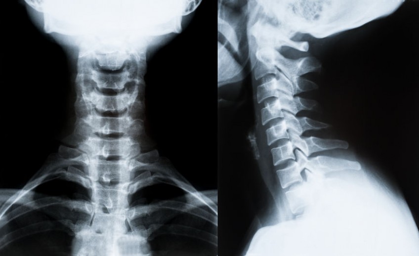 RX-CERVICALE-848×518