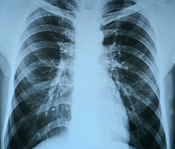 pneumonia test scanning, modern x-rays radiography